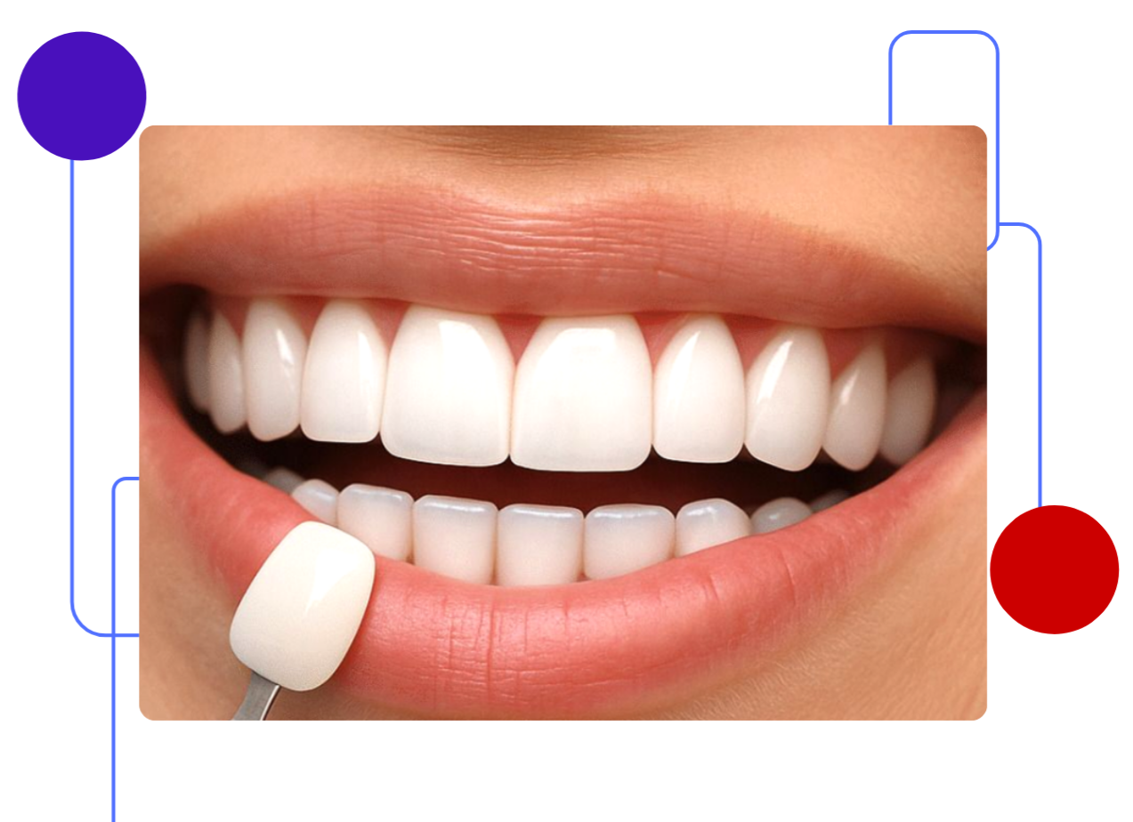 Porcelain Veneer at Watervale Dental